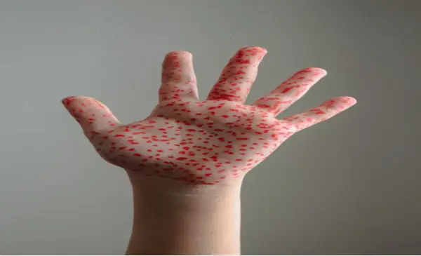 An infant in Alberta has died from measles, second death in Canada from disease this year
