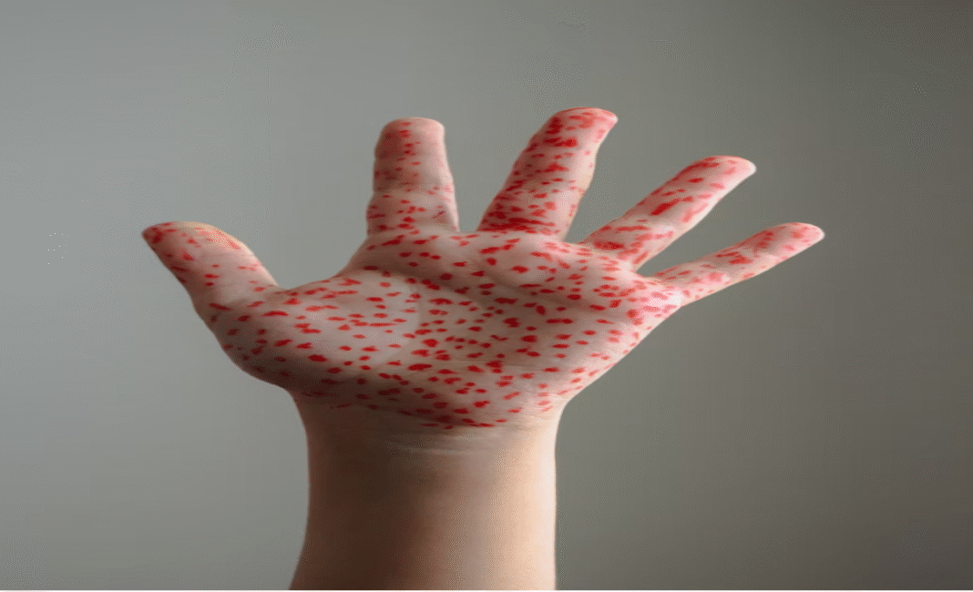 Canada loses measles elimination status after year-long outbreak