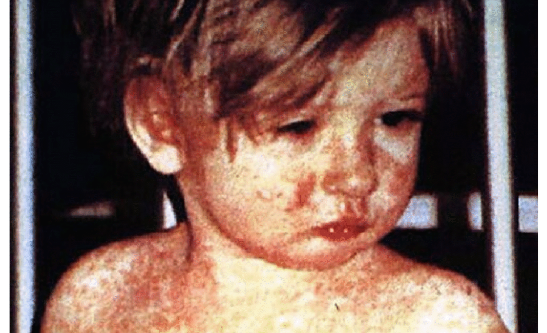 Sudbury region of Ontario reports dozens of measles cases amid ongoing outbreak