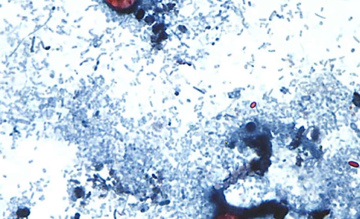 Massive Parasite Outbreak Spreads to 9 States