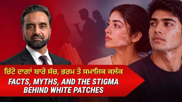 Vitiligo: ਚਿੱਟੇ ਦਾਗਾਂ ਬਾਰੇ ਸੱਚ, ਭਰਮ ਤੇ ਸਮਾਜਿਕ ਕਲੰਕ | Facts, Myths & the Stigma Behind White Patches
